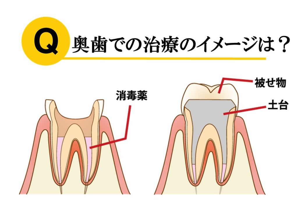 虫歯の処置について 神経の処置 名古屋駅で歯列矯正なら名駅アール歯科 矯正歯科